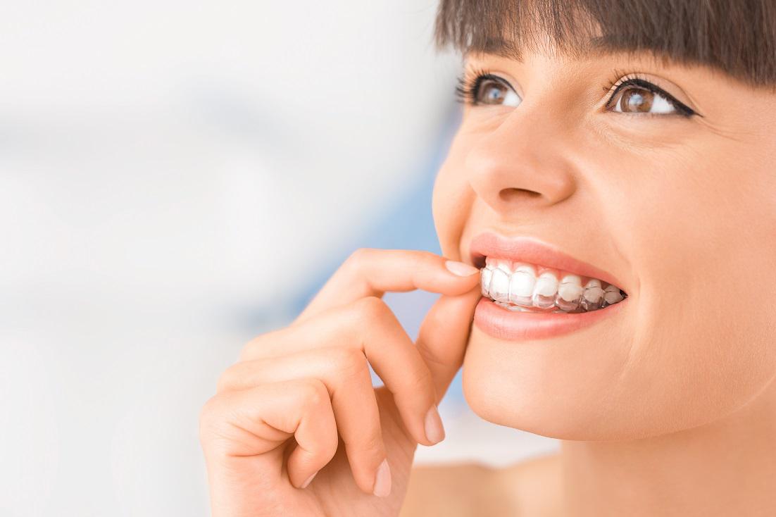 Invisalign® Treatment for Clear Aligners, Invisalign Aligners Technology