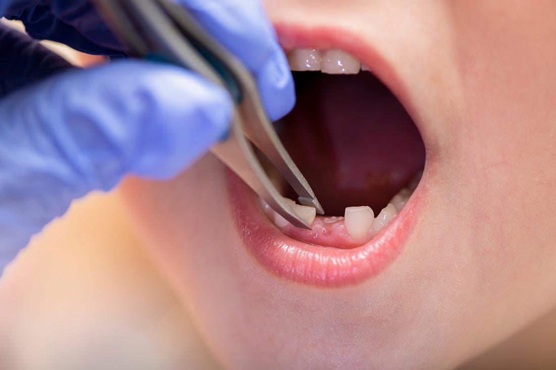 Should You Pull A Kids Tooth Out?